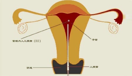 代孕